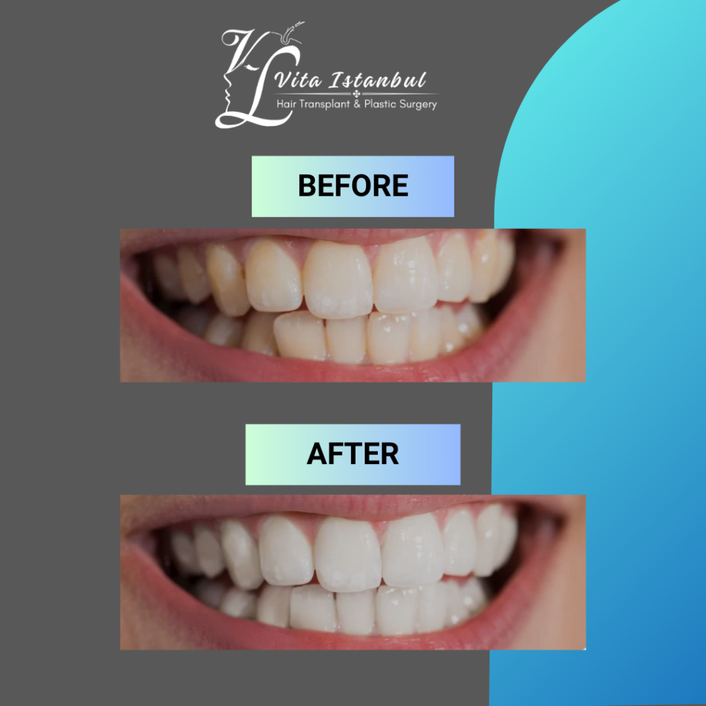 Teeth whitening Vita Istanbul